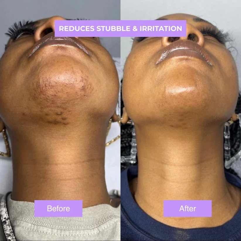 Cyphera™ - Cyperus Rotundus Skin Serum